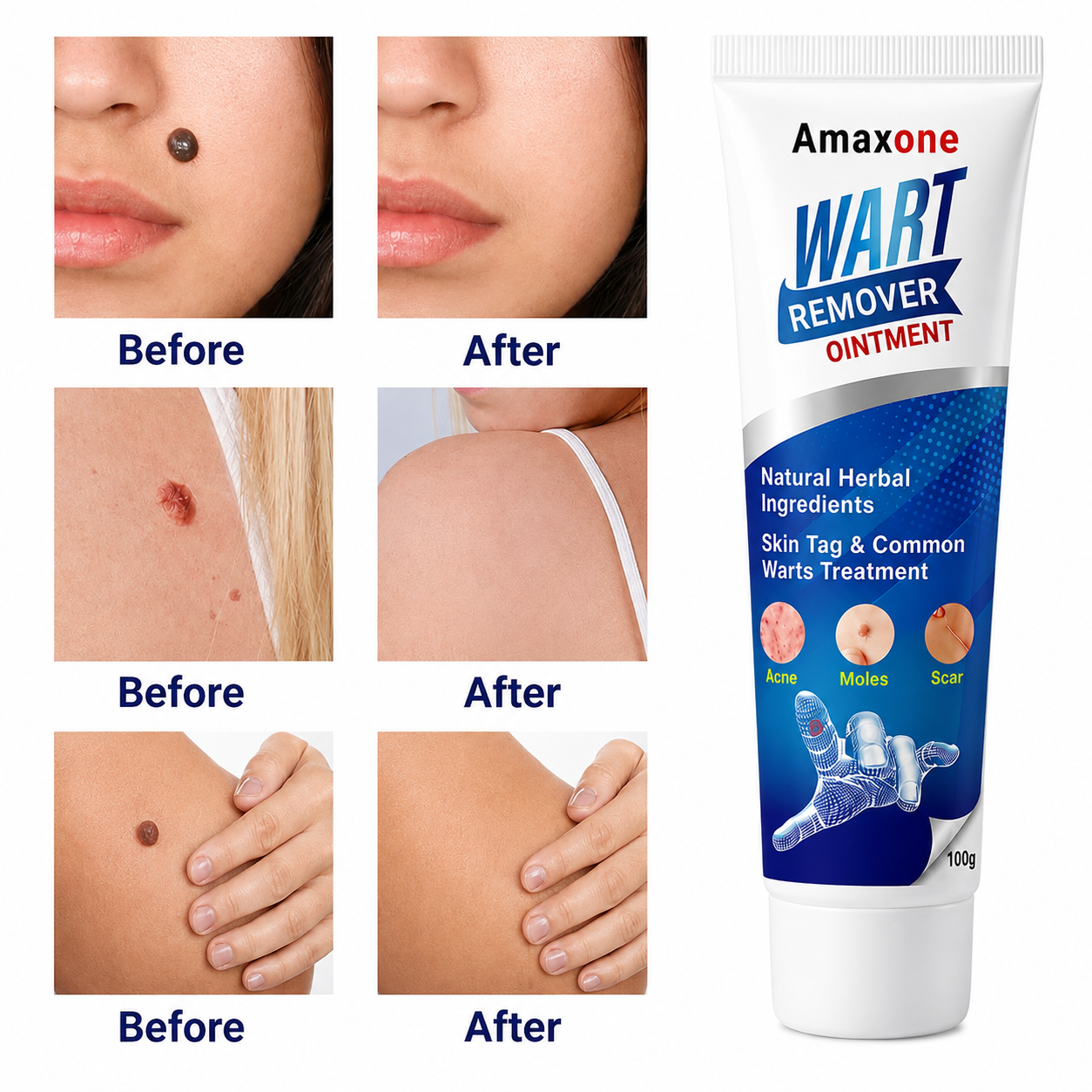 Wart Removal Ointment Cream – Fast Acting Skin Tag & Common Wart Remover for Clear, Smooth Skin