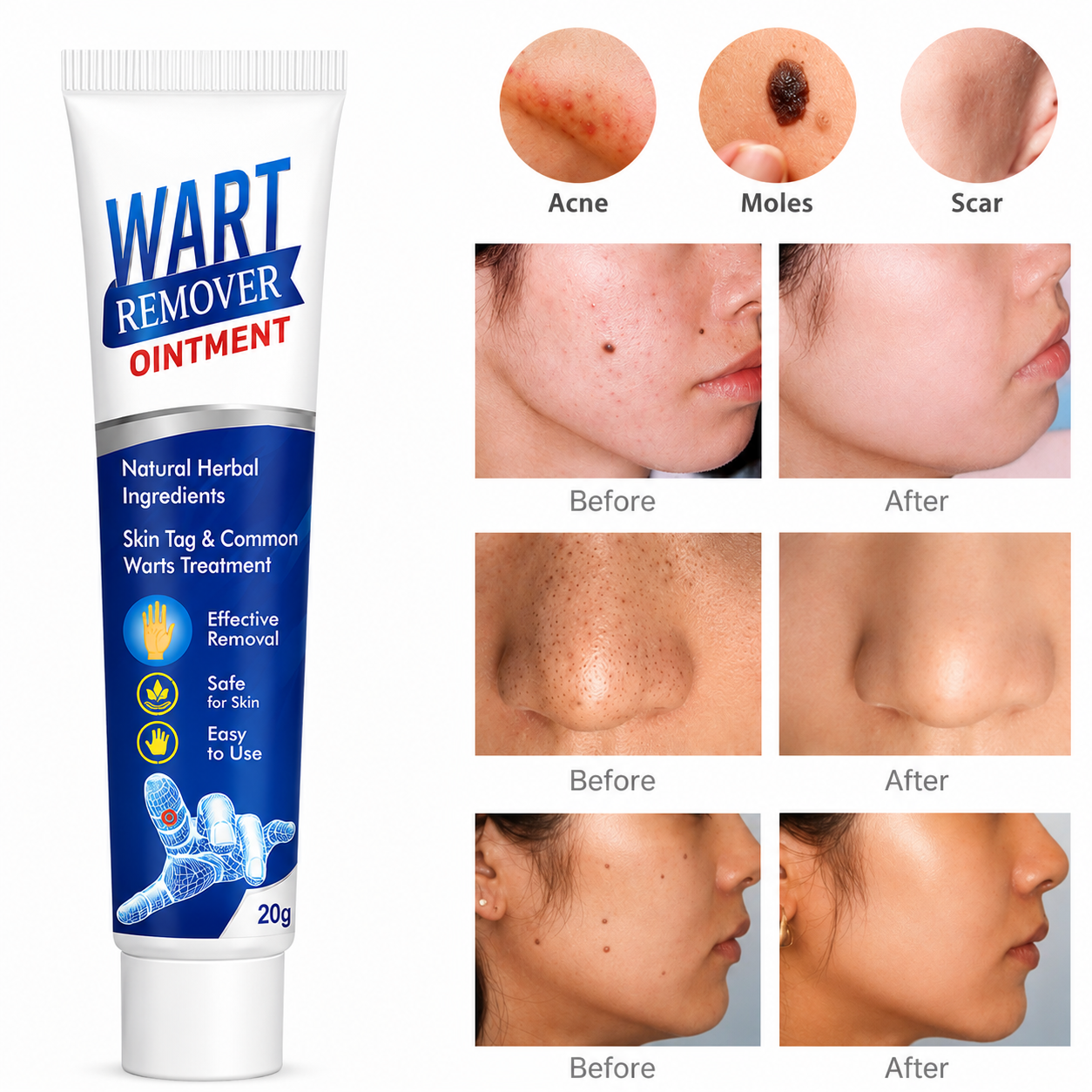 Wart Removal Ointment Cream – Fast Acting Skin Tag & Common Wart Remover for Clear, Smooth Skin
