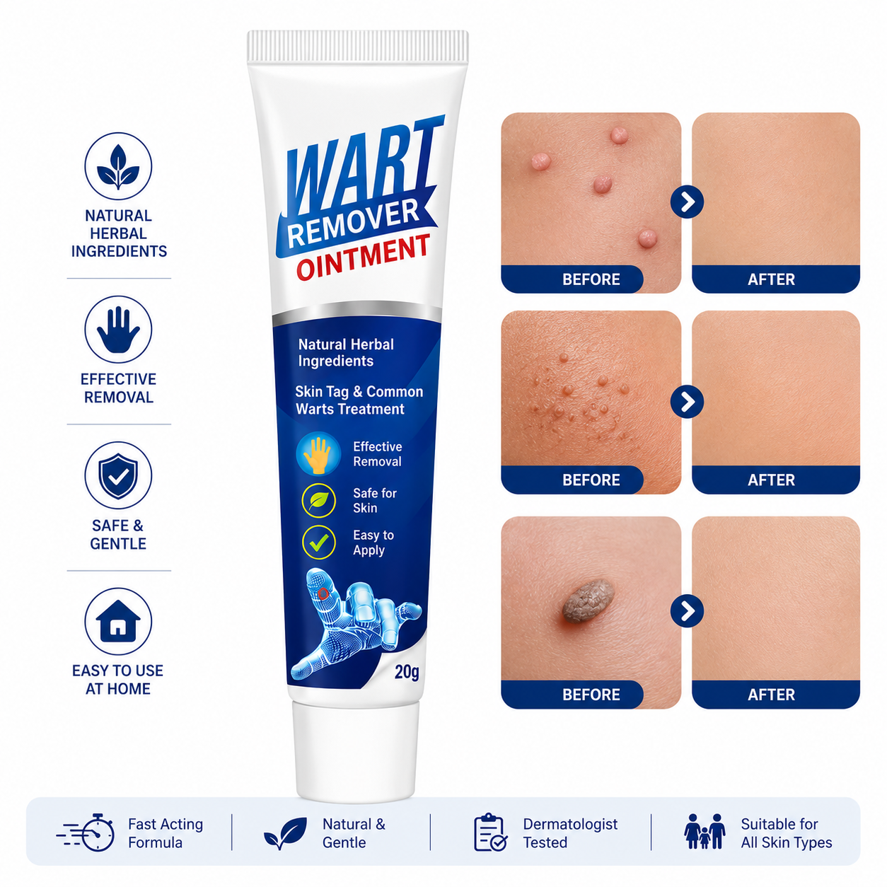 Wart Removal Ointment Cream – Fast Acting Skin Tag & Common Wart Remover for Clear, Smooth Skin