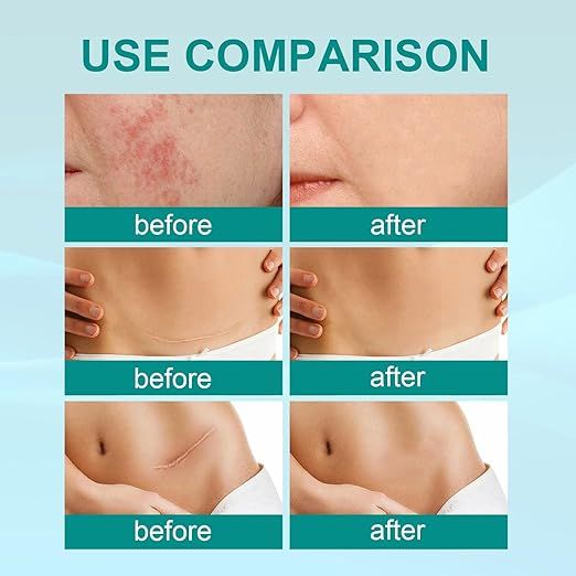 Medical Scar removal spray
