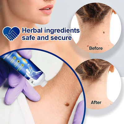 Wart Remover Review by Omar Al Shamsi